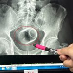 Teacup found in man’s bottom after he went to hospital complaining of constipation