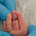 Midwife suspended after nearly cutting baby’s finger off when she was severing his umbilical cord moments after birth